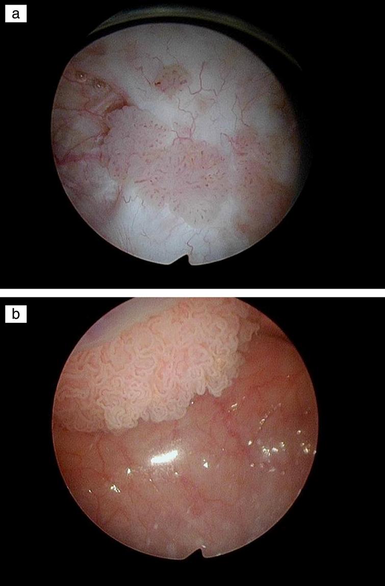 Case 8 NF | Bladder Cancer